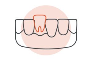 Graphic Icon Showing a Tooth That Does Not Fit Between Two Other Teeth