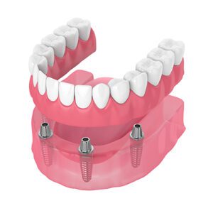Graphic Depicting Dental Implants for an Entire Arch of Teeth