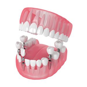 Graphic Depicting Dental Implants for Multiple Missing Teeth